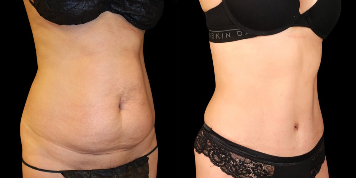 Abdominoplasty (Tummy Tuck) Before & After Gallery - Patient 371350 - Image 2