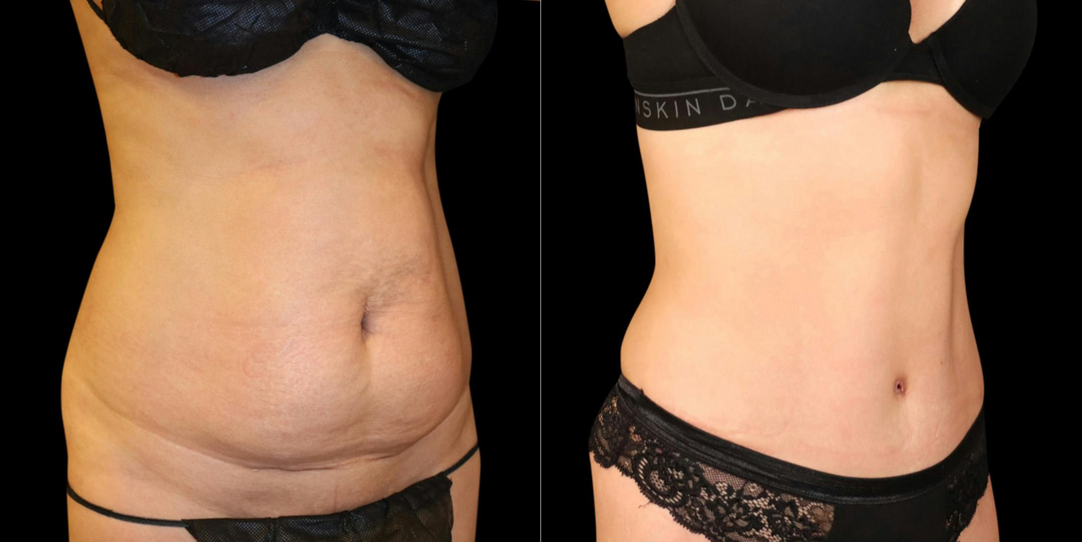 Abdominoplasty (Tummy Tuck) Before & After Gallery - Patient 371350 - Image 2