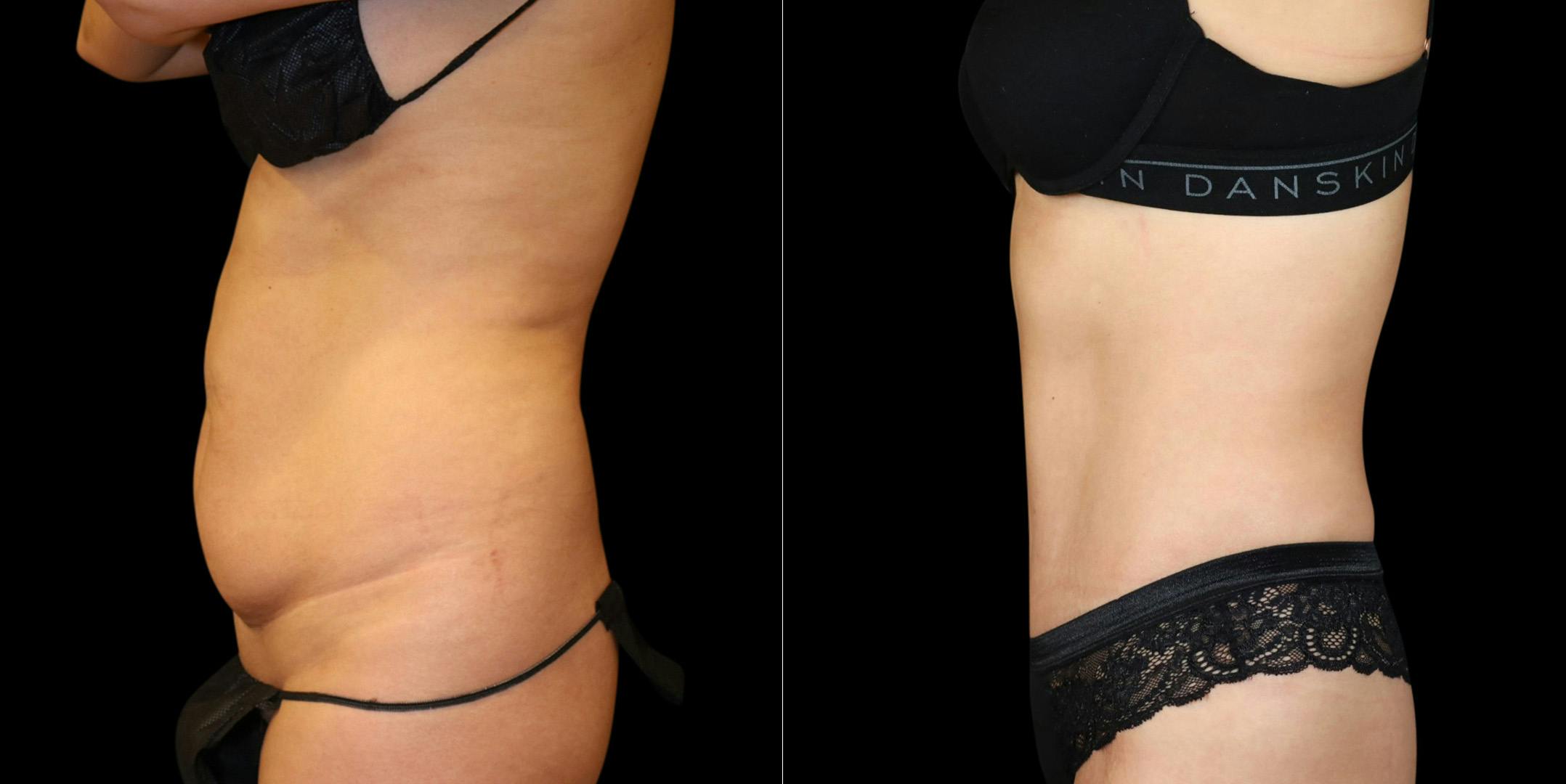 Abdominoplasty (Tummy Tuck) Before & After Gallery - Patient 371350 - Image 5
