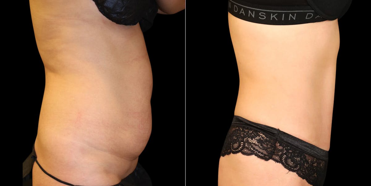 Abdominoplasty (Tummy Tuck) Before & After Gallery - Patient 371350 - Image 3