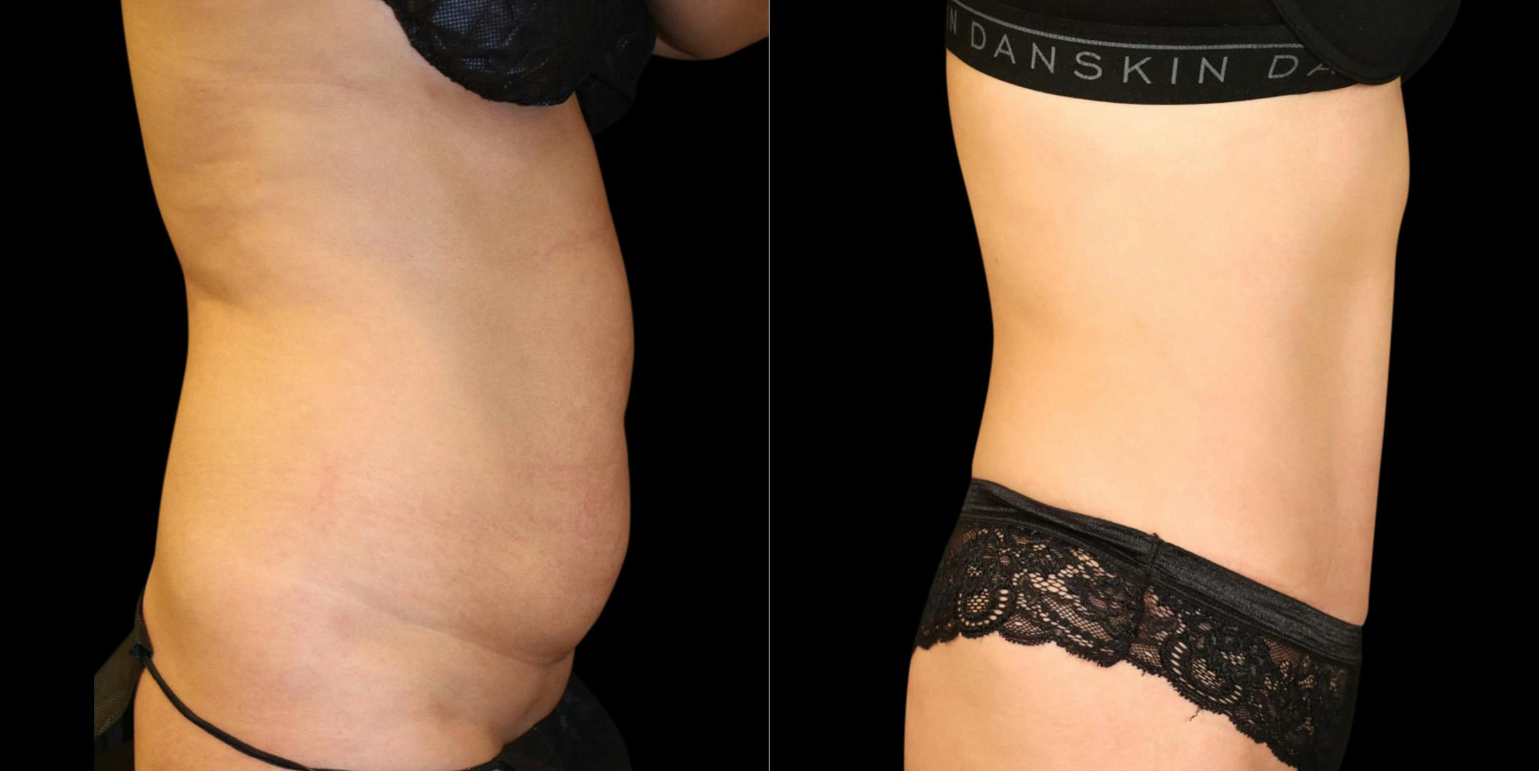 Abdominoplasty (Tummy Tuck) Before & After Gallery - Patient 371350 - Image 3