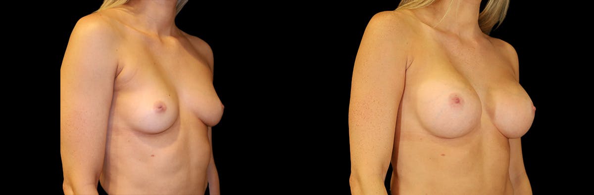 Breast Augmentation Before & After Gallery - Patient 142877 - Image 2