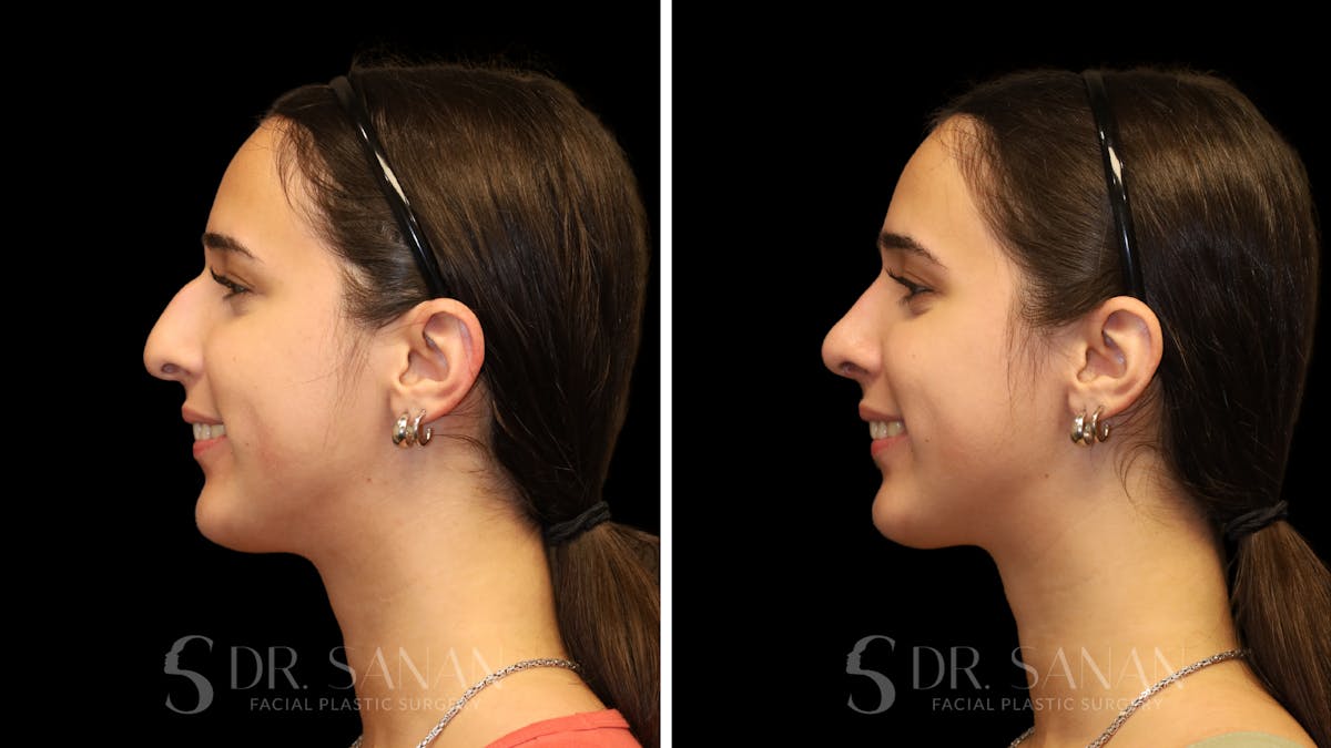 Rhinoplasty Before & After Gallery - Patient 954823 - Image 7