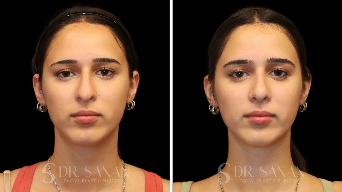 Rhinoplasty Before & After Gallery - Patient 954823 - Image 4