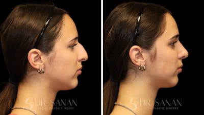 Rhinoplasty Before & After Gallery - Patient 954823 - Image 1