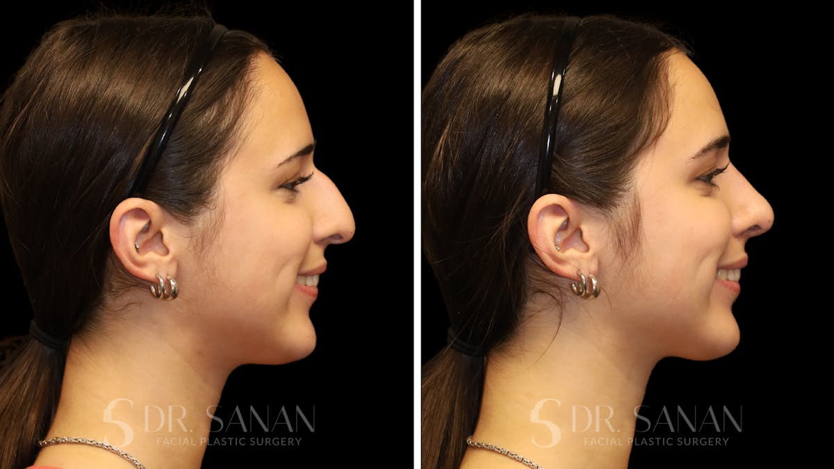 Rhinoplasty Before & After Gallery - Patient 954823 - Image 2