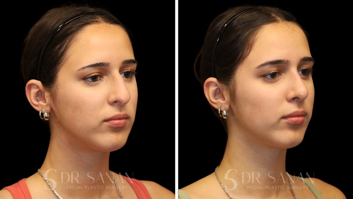 Rhinoplasty Before & After Gallery - Patient 954823 - Image 3