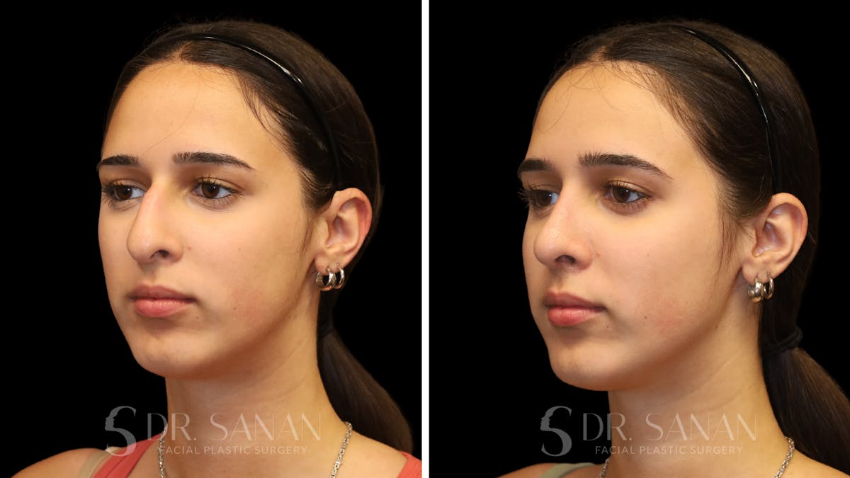 Rhinoplasty Before & After Gallery - Patient 954823 - Image 5