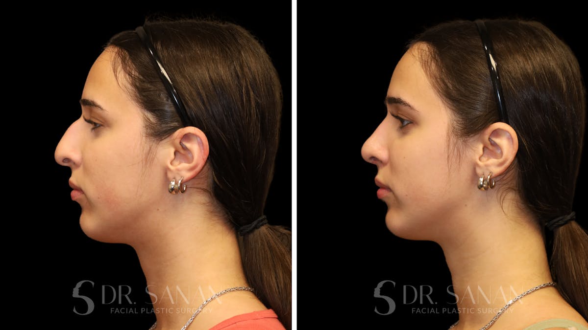 Rhinoplasty Before & After Gallery - Patient 954823 - Image 6