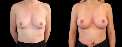 Breast Augmentation Before & After Gallery - Patient 320290 - Image 1