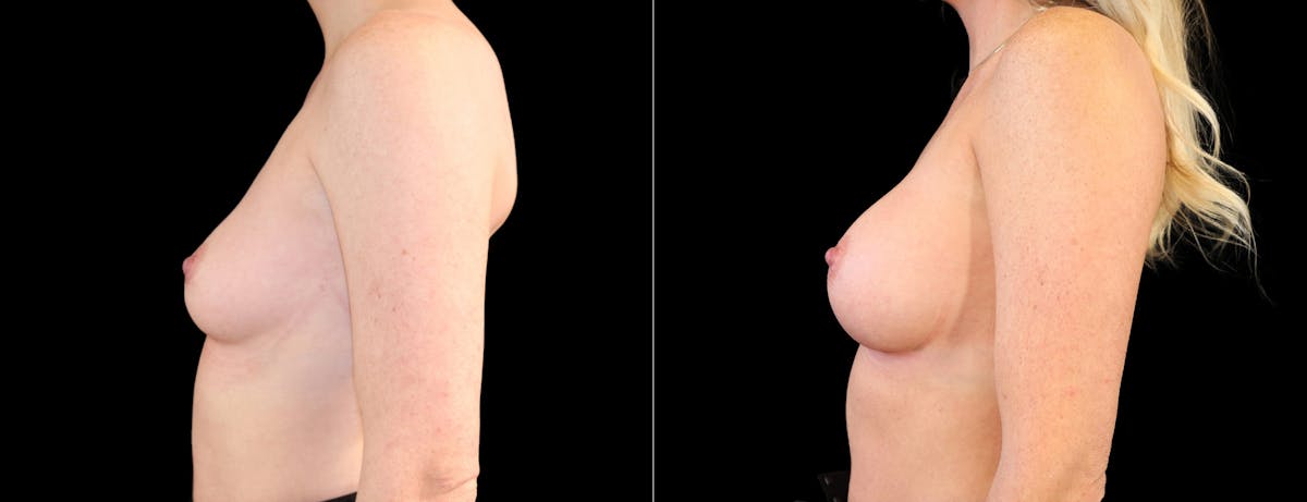 Breast Augmentation Before & After Gallery - Patient 320290 - Image 5