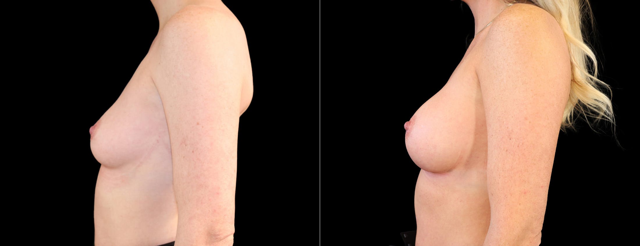 Breast Augmentation Before & After Gallery - Patient 320290 - Image 5