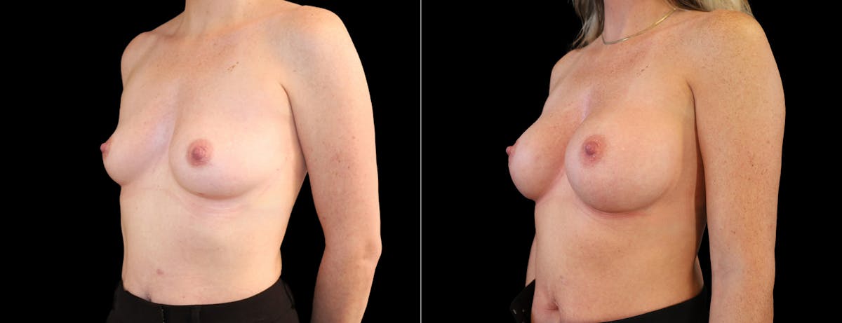 Breast Augmentation Before & After Gallery - Patient 320290 - Image 4