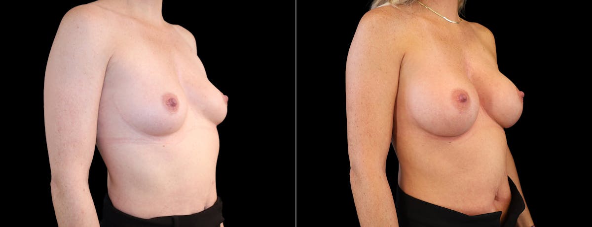 Breast Augmentation Before & After Gallery - Patient 320290 - Image 2