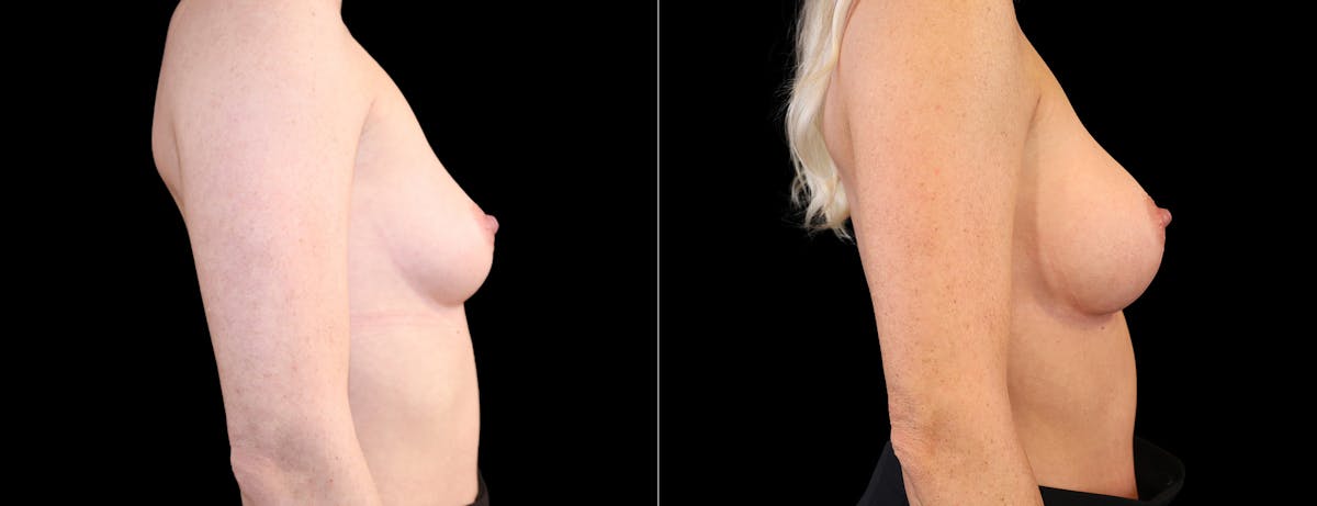 Breast Augmentation Before & After Gallery - Patient 320290 - Image 3