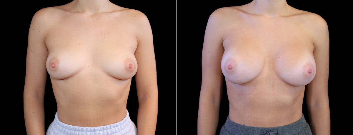 Breast Augmentation Before & After Gallery - Patient 410879 - Image 1