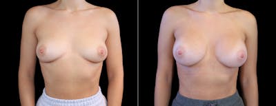 Breast Augmentation Before & After Gallery - Patient 410879 - Image 1