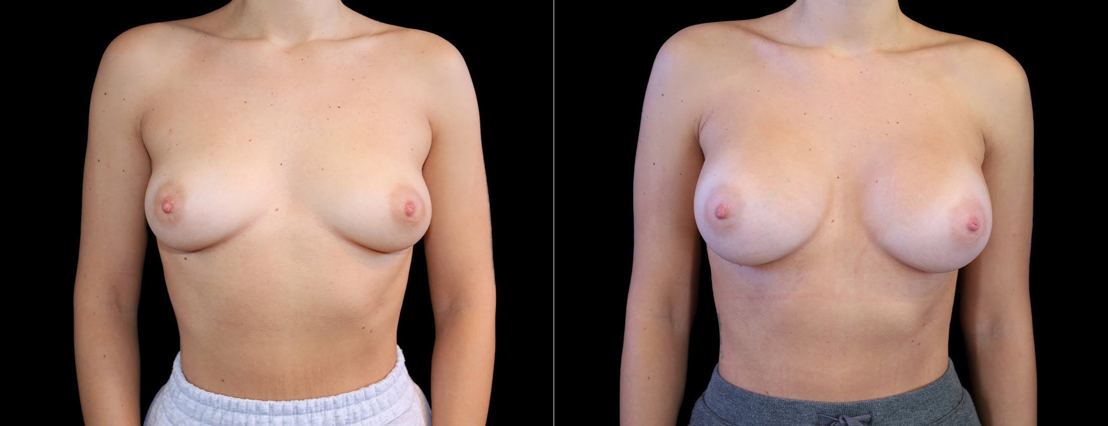 Breast Augmentation Before & After Gallery - Patient 410879 - Image 1