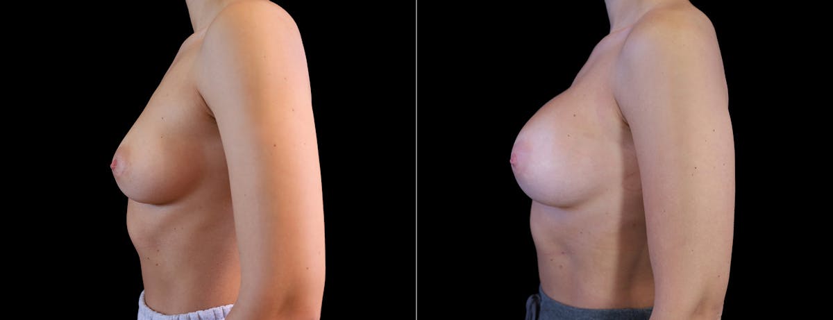 Breast Augmentation Before & After Gallery - Patient 410879 - Image 5