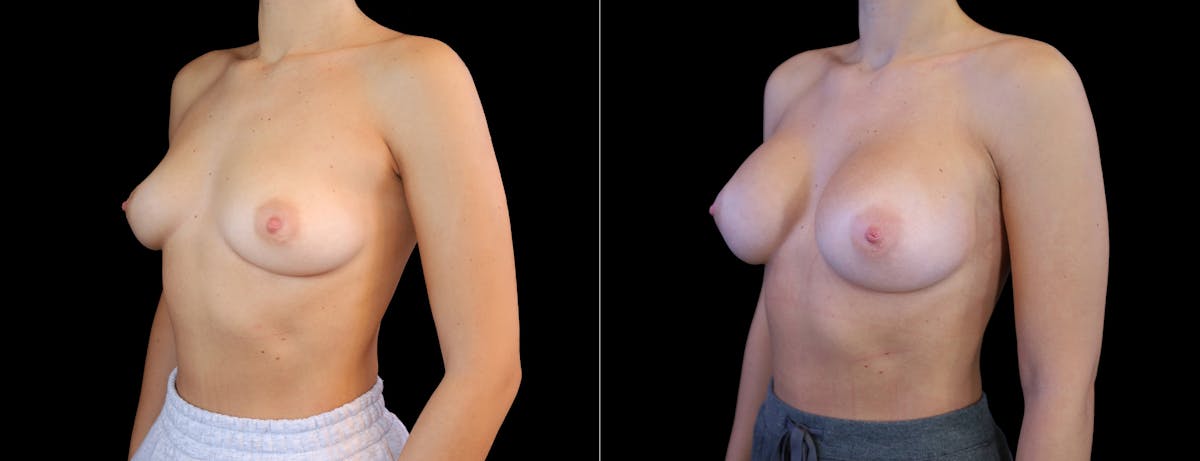 Breast Augmentation Before & After Gallery - Patient 410879 - Image 4