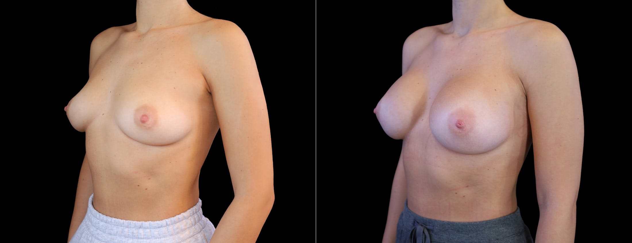 Breast Augmentation Before & After Gallery - Patient 410879 - Image 4