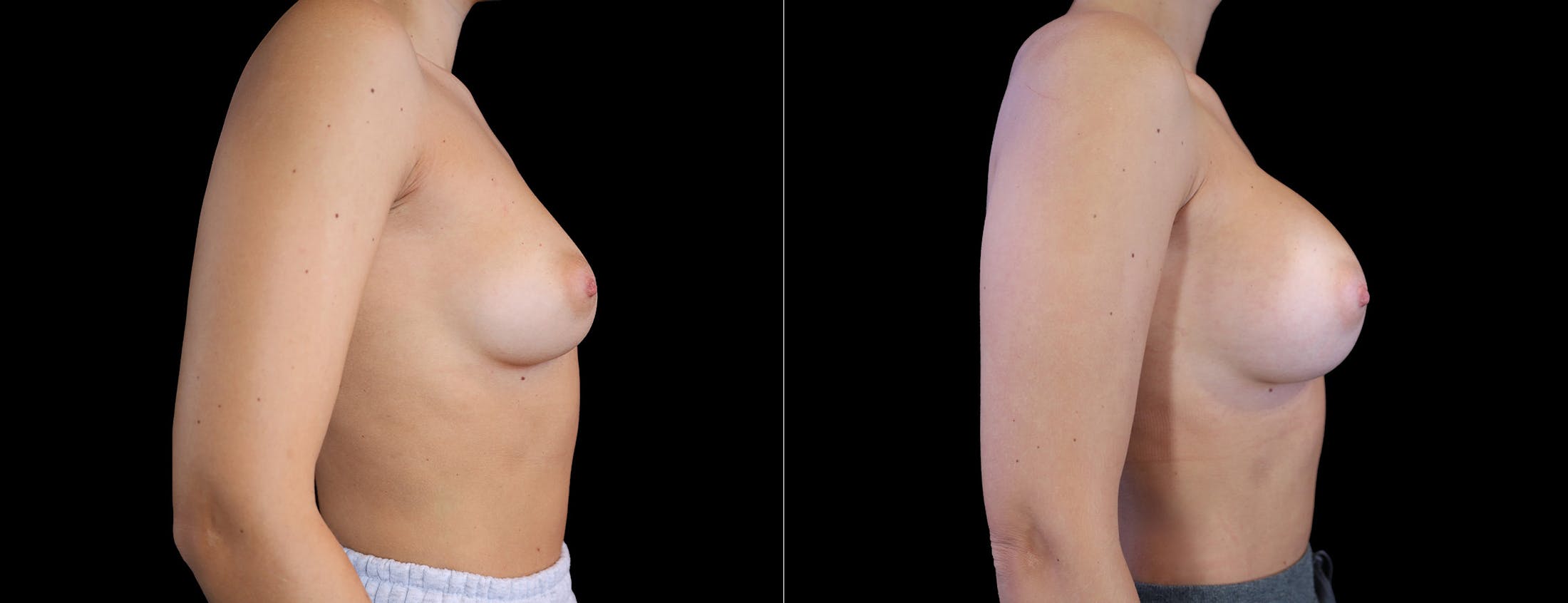 Breast Augmentation Before & After Gallery - Patient 410879 - Image 3