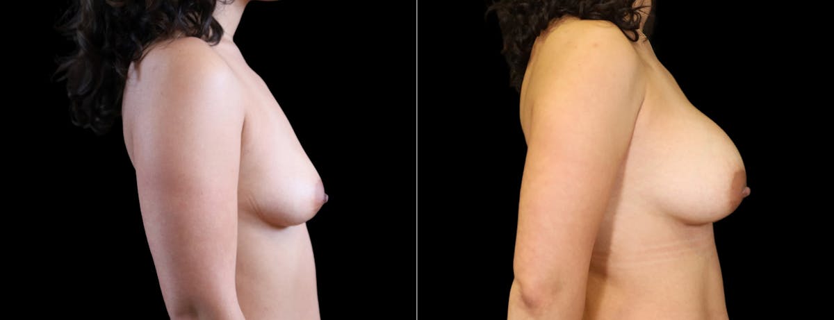 Breast Augmentation Before & After Gallery - Patient 177034 - Image 3