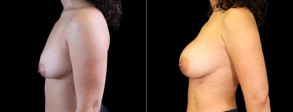 Breast Augmentation Before & After Gallery - Patient 177034 - Image 5