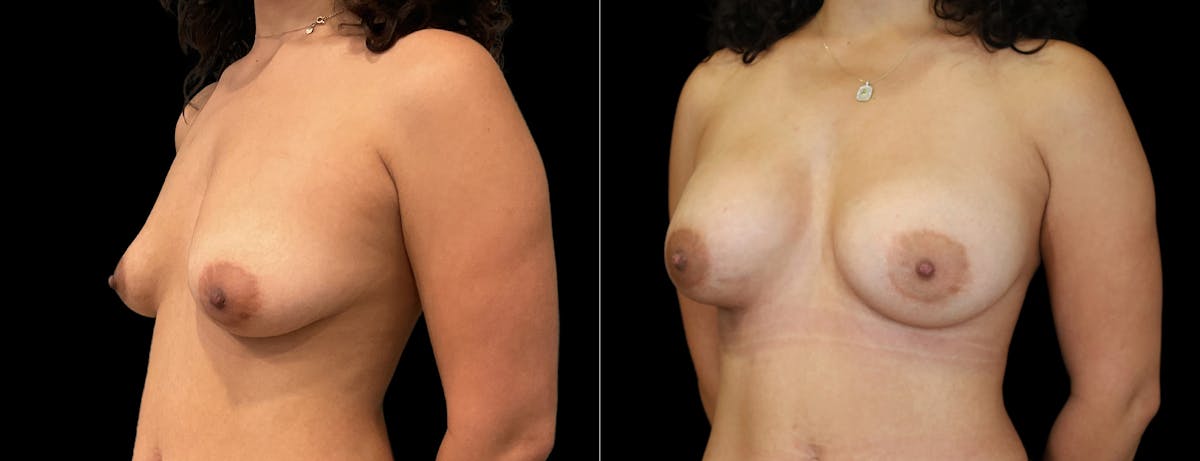 Breast Augmentation Before & After Gallery - Patient 177034 - Image 4