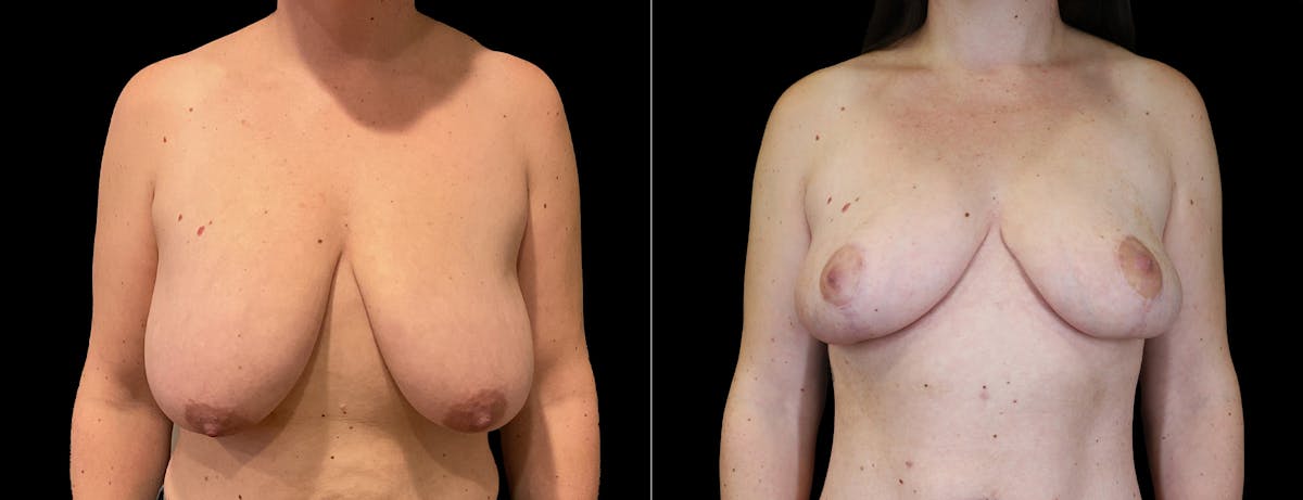 Breast Lift Before & After Gallery - Patient 197388 - Image 1