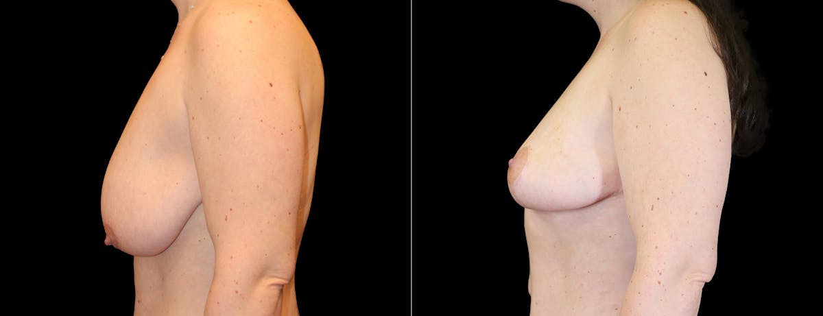 Breast Lift Before & After Gallery - Patient 197388 - Image 3