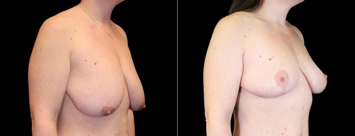 Breast Lift Before & After Gallery - Patient 197388 - Image 2
