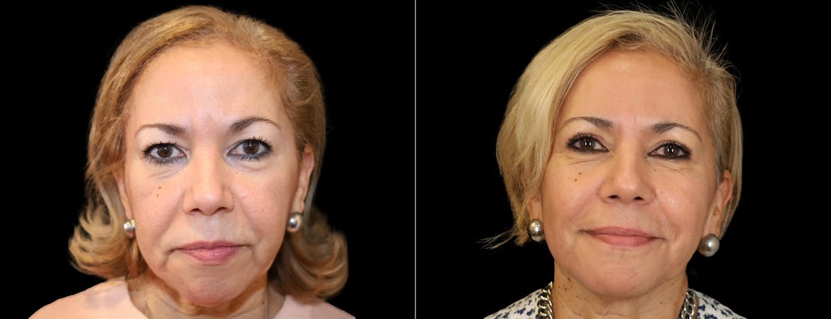 Blepharoplasty Before & After Gallery - Patient 232741 - Image 1