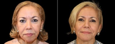 Blepharoplasty Before & After Gallery - Patient 232741 - Image 1