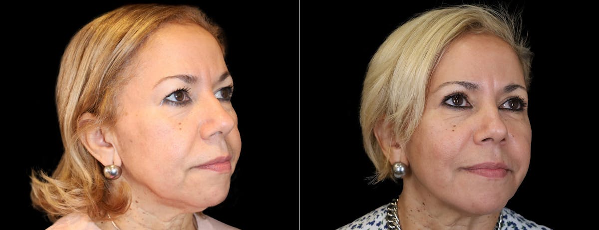 Blepharoplasty Before & After Gallery - Patient 232741 - Image 2