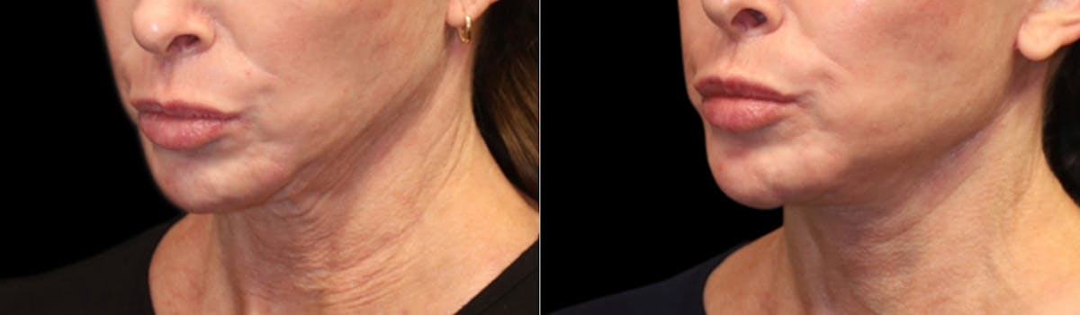 Deep Plane Facelift Before & After Gallery - Patient 396546 - Image 3