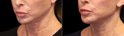 Facelift LP (Branded - 3 Doctors) Before & After Gallery - Patient 120730 - Image 1