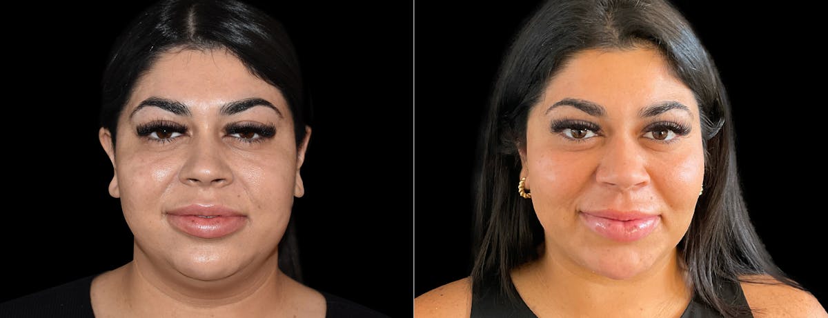 Buccal Fat Reduction Before & After Gallery - Patient 170861 - Image 1