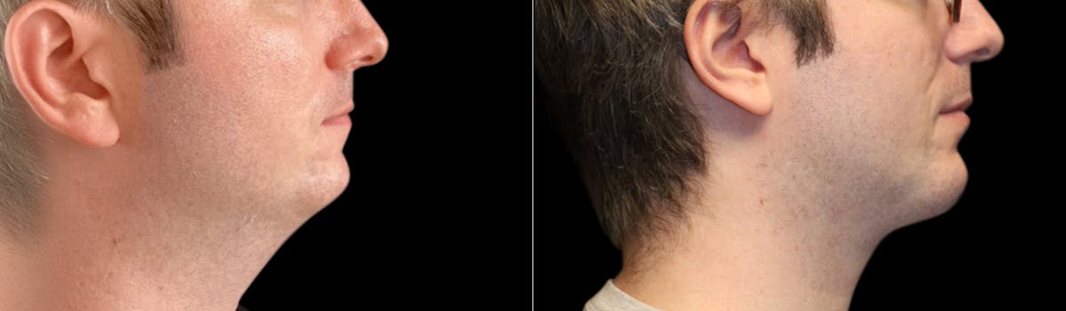 Chin Augmentation Before & After Gallery - Patient 240330 - Image 7