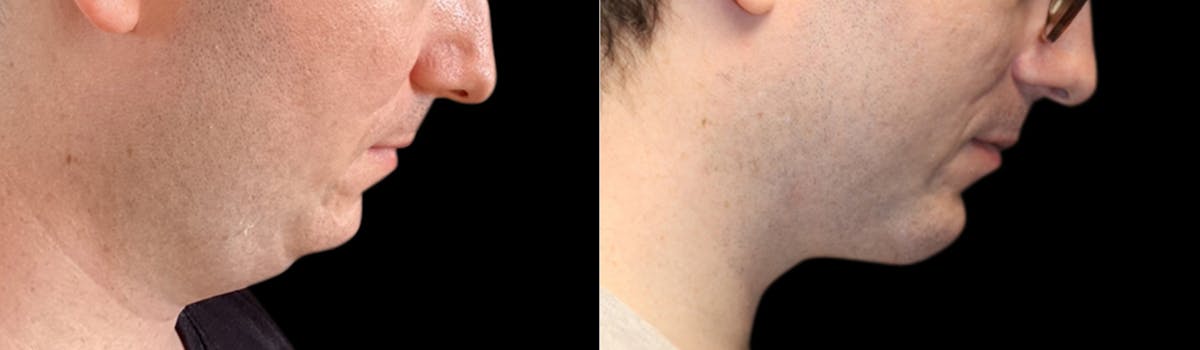 Chin Augmentation Before & After Gallery - Patient 240330 - Image 9