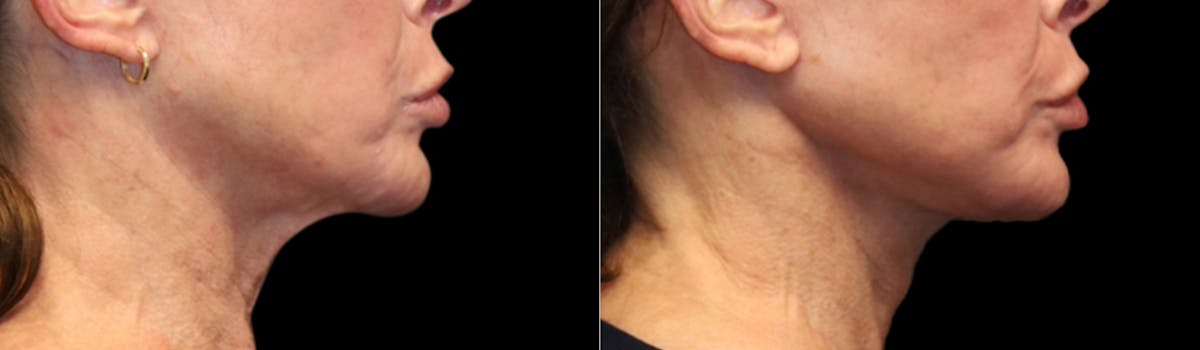 Deep Plane Facelift Before & After Gallery - Patient 396546 - Image 7