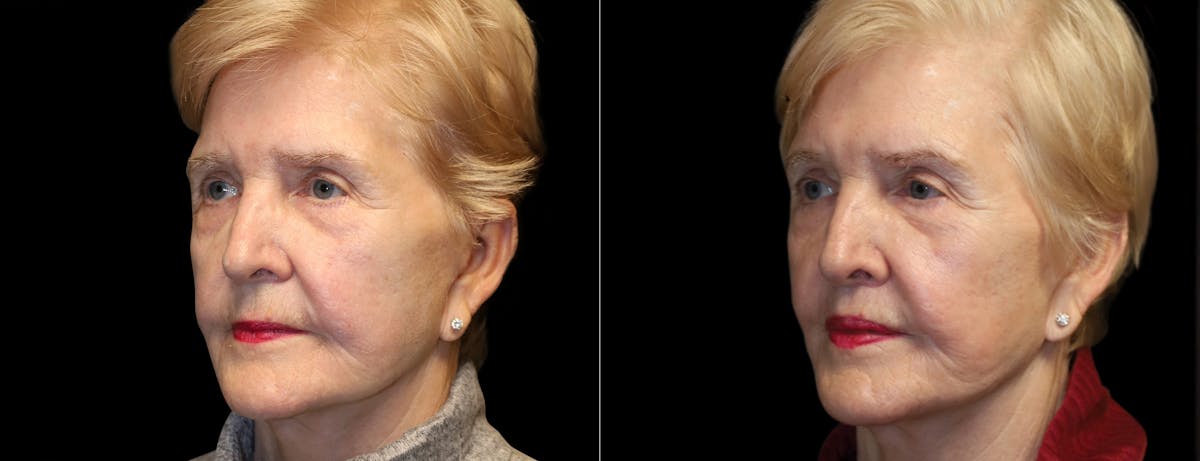 Lip Lift Before & After Gallery - Patient 972339 - Image 2