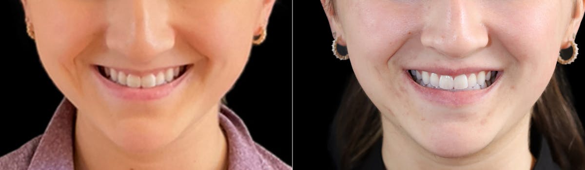 Lip Augmentation Before & After Gallery - Patient 385367 - Image 2
