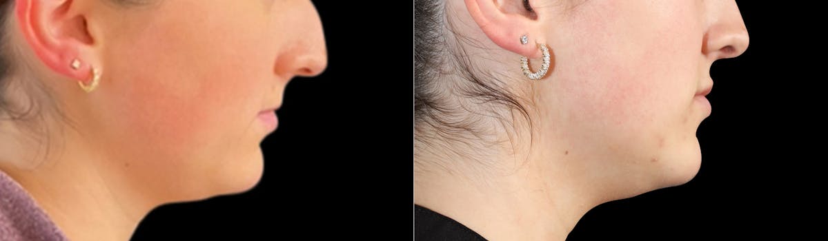 Lip Augmentation Before & After Gallery - Patient 385367 - Image 4