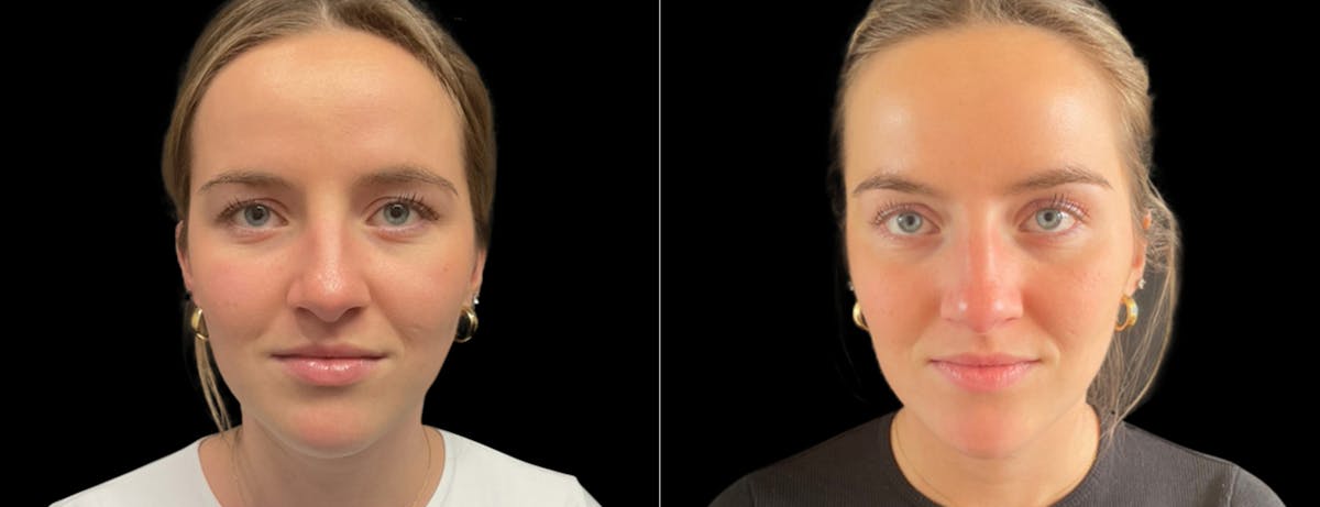 Botox Before & After Gallery - Patient 271724 - Image 1