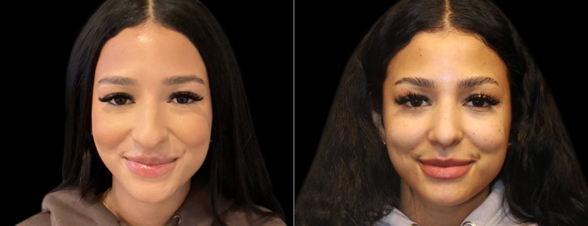 Rhinoplasty Before & After Gallery - Patient 337396 - Image 3