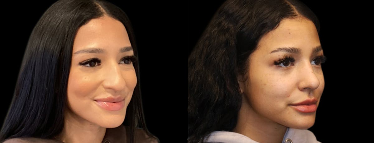 Rhinoplasty Before & After Gallery - Patient 337396 - Image 5