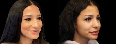 Rhinoplasty Before & After Gallery - Patient 337396 - Image 1