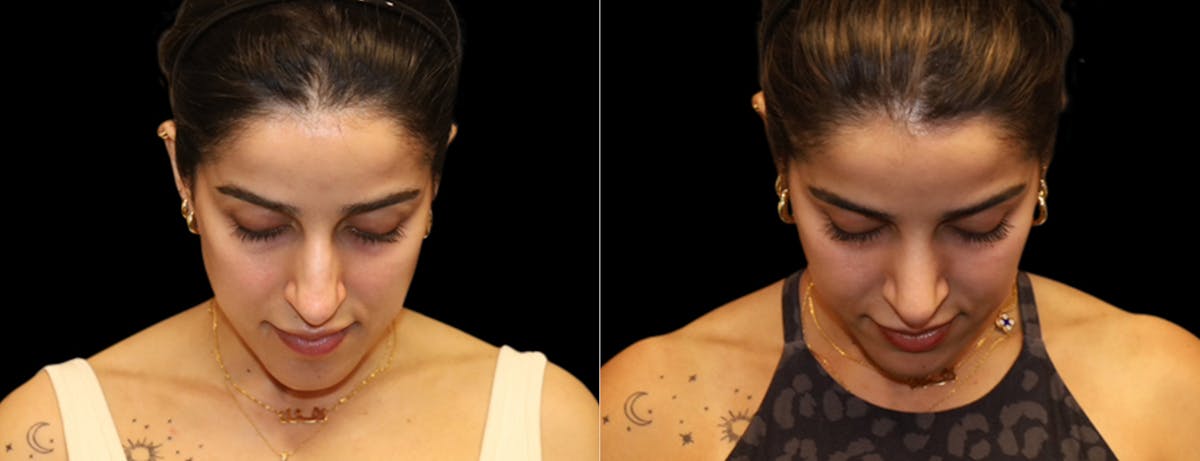 Rhinoplasty Before & After Gallery - Patient 149753 - Image 7