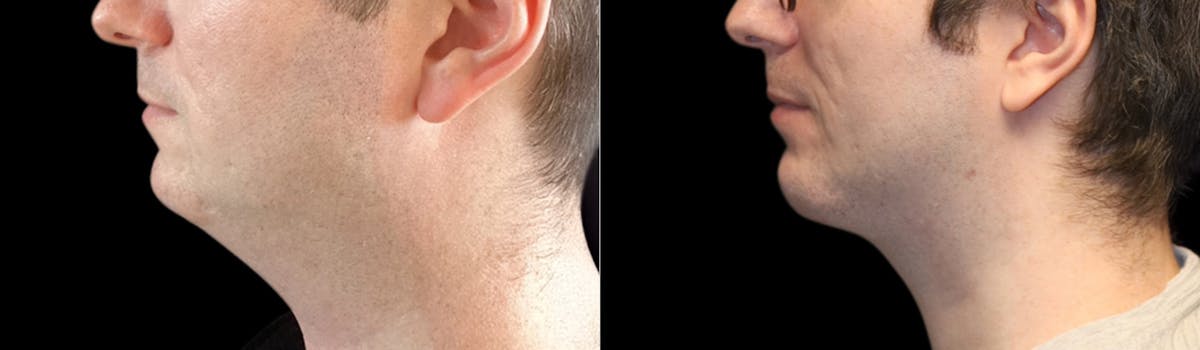 Chin Augmentation Before & After Gallery - Patient 240330 - Image 1